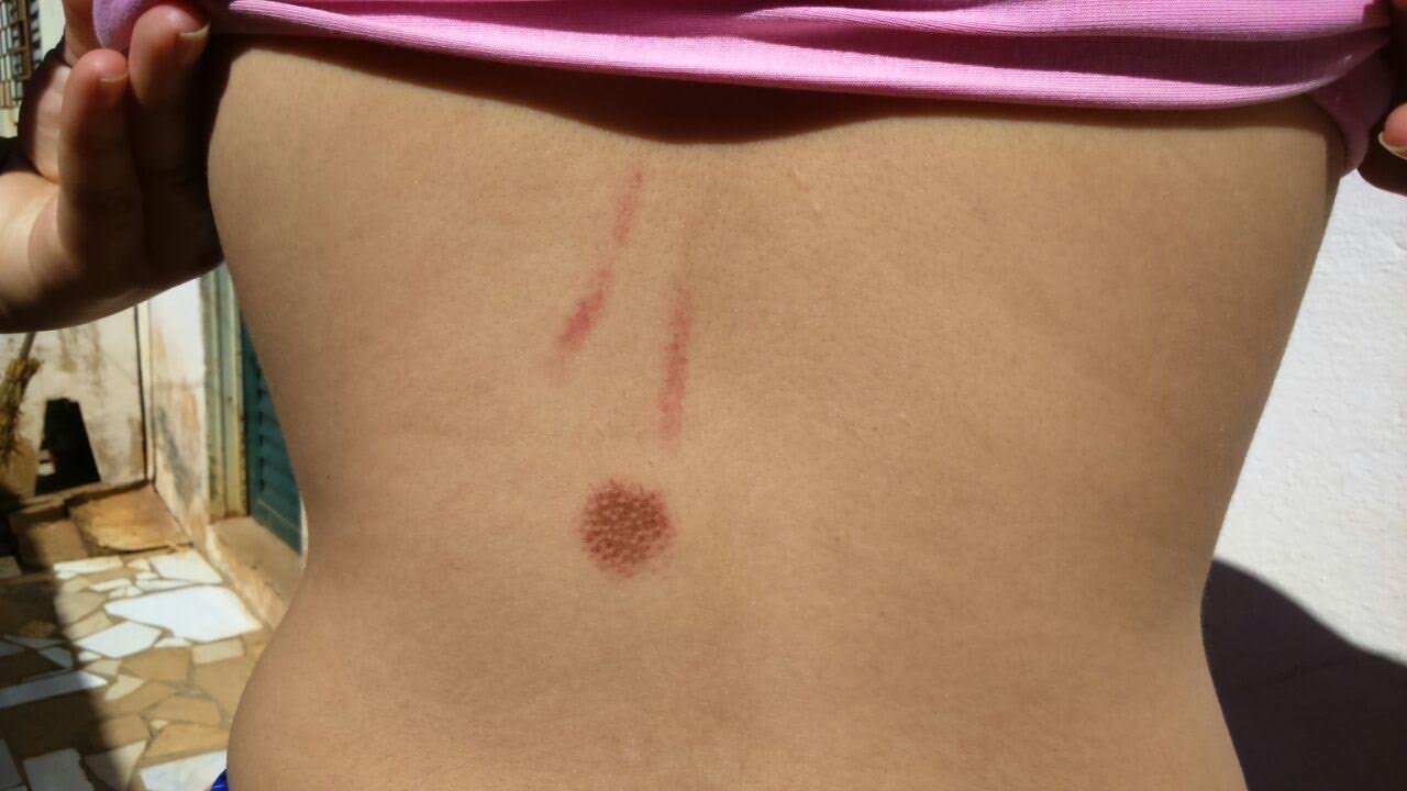 Marcas da agressão ficaram nas costas, na cabeça depois de levar socos, pauladas e golpes em barras de ferro